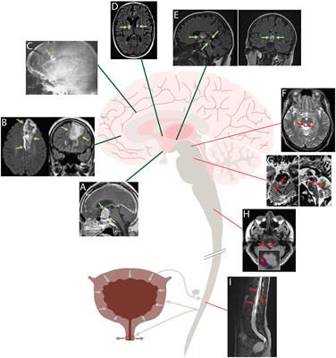 The Brain and the Bladder: Forebrain Control of Urinary (In)Continence